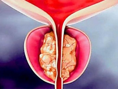 Urologist: Try This If You Have An Enlarged Prostate (Watch)